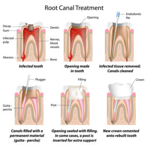 info graphic explaining the stages of an root canal treatment